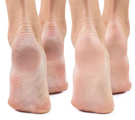 What Causes Dry Skin On Heels Of Feet